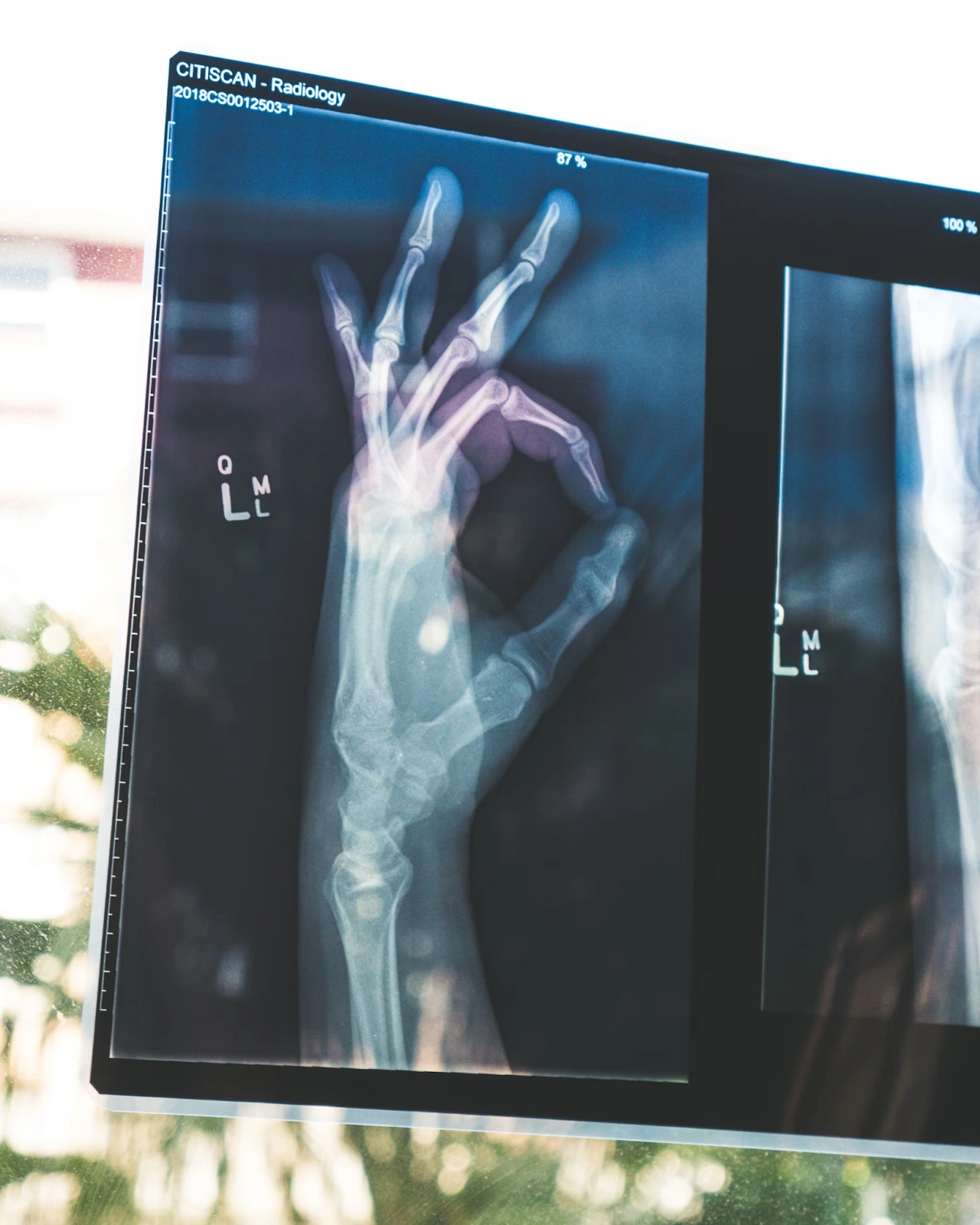 An X-ray of a hand having an OK hand gesture