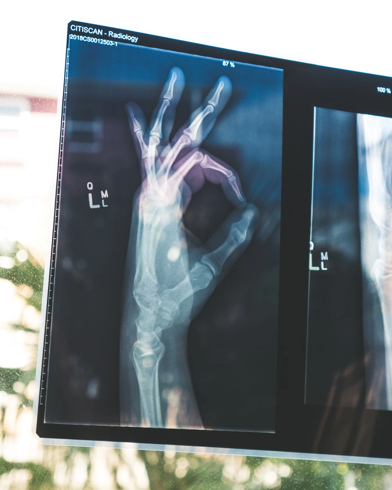 Blockchain Technology in Healthcare An X-ray of a hand having an OK hand gesture